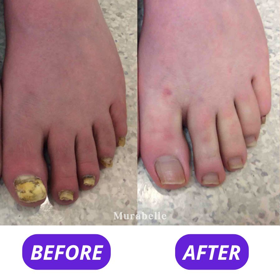 Fungi Free - Bee Venom Fungus Treatment