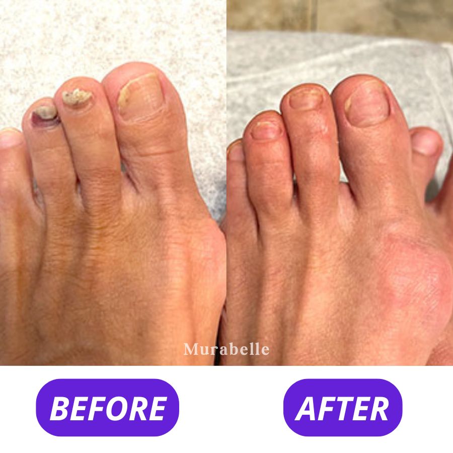 Fungi Free - Bee Venom Fungus Treatment